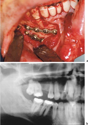 mandible fracture wiring