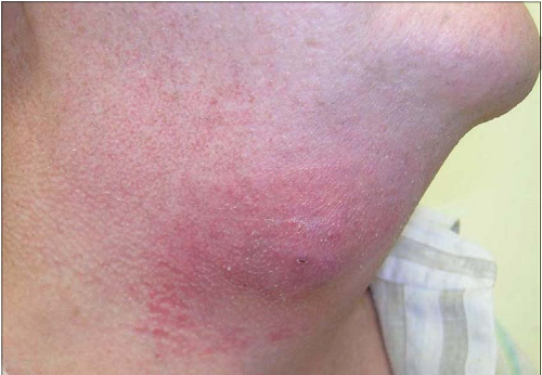 cellulitis neck