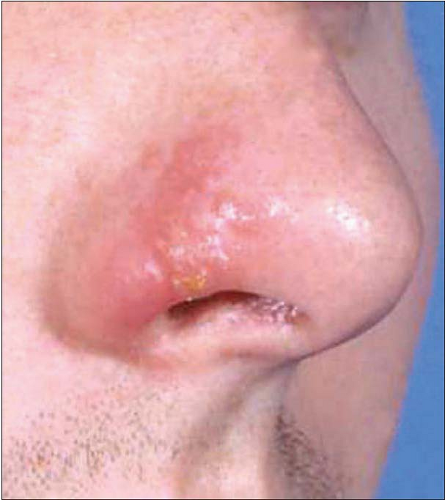 nasal cold sores