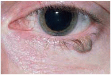 skin growth on eyelid