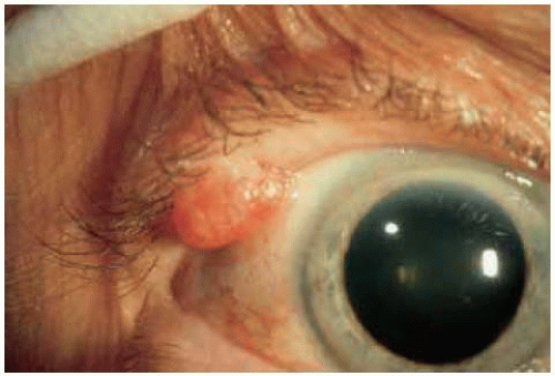 papilloma eyelid