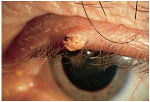 verruca vulgaris eyelid