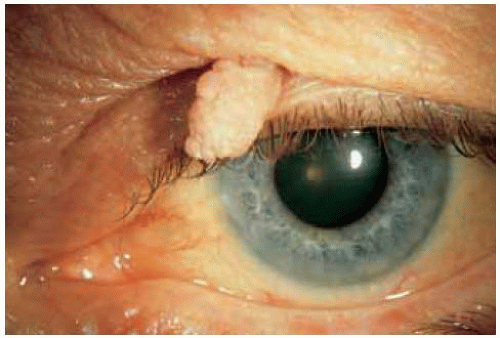 Benign Tumors Of The Eyelid Epidermis Ento Key 