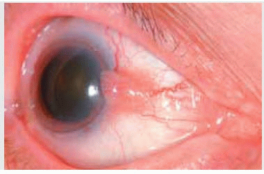 conjunctival intraepithelial neoplasia