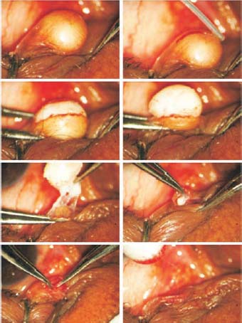 When Are Sebaceous Cysts Cause for Concern?: Lakeland Surgical