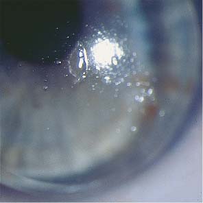 protein deposits on contacts cleaner