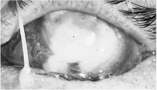 Bacterial Keratitis | Ento Key