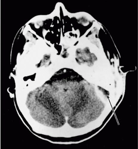 Acute Mastoiditis Ento Key 1188