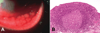 follicular conjunctivitis histology