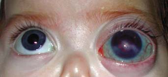 unilateral blown pupil