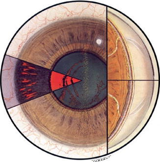 Office Examination of the Glaucoma Patient | Ento Key
