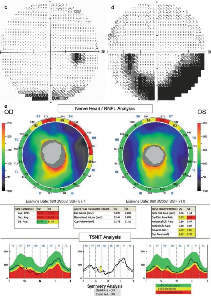 Diagnosis and Progression: RNFL and Optic Nerve Head Imaging - American  Academy of Ophthalmology