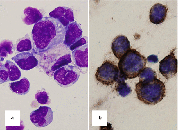 Intraocular Lymphoma | Ento Key