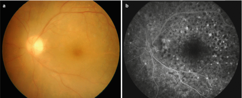 presentation of primary intraocular lymphoma