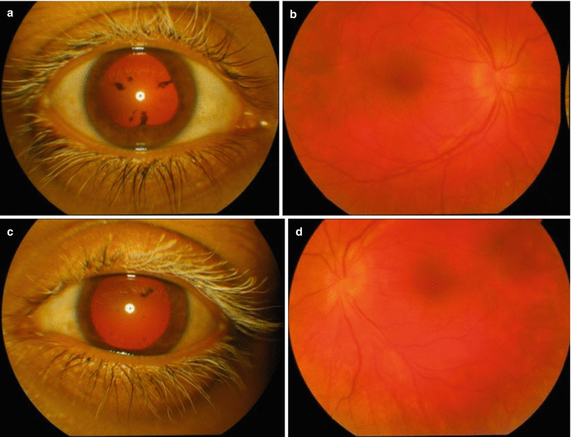 acute uveitis