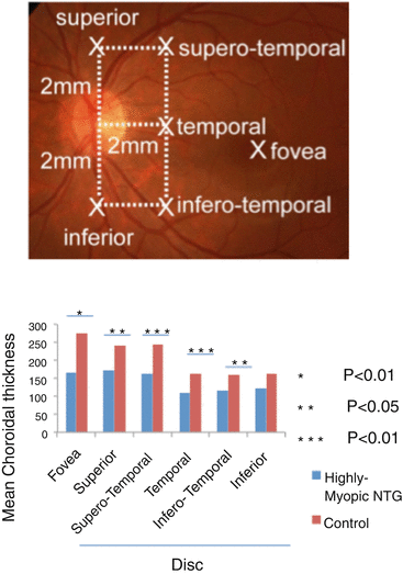 High Myopia And Myopic Glaucoma: Findings In The Peripapillary Retina ...