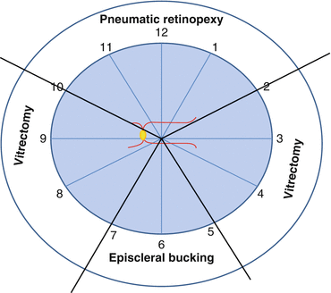 Retinal Detachment Ento Key