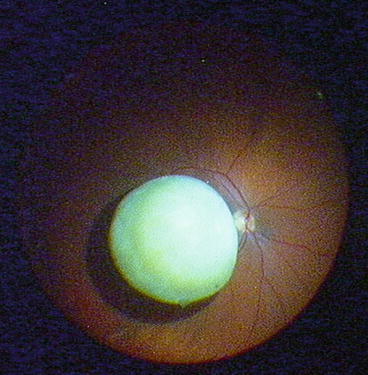 dropped lens nucleus icd 10