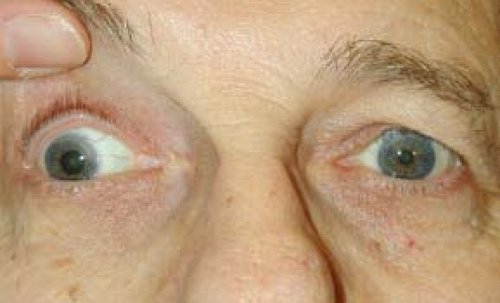 cniii compression and fixed dilated pupil