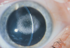 cornea dystrophy cloudy central refractive disease surgery external francois entokey