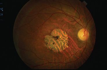 retinal dystrophy cone rod choroidal generalized sheen diseases atrophy macular patient subtle linked figure there