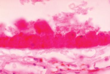 19 Stargardt Disease Fundus Flavimaculatus Ento Key