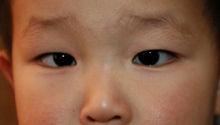 Strabismus Disorders Ento Key Types of epicanthal folds including their causes, diagnosis, and related symptoms from a list of 188 total causes of symptom epicanthal folds. strabismus disorders ento key