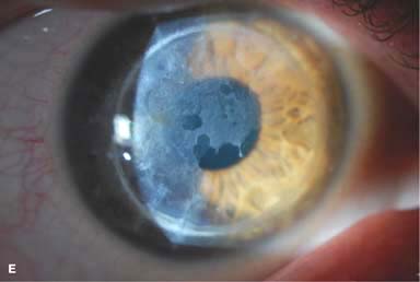 corneal dystrophy epithelial dystrophies gelatinous drop entokey
