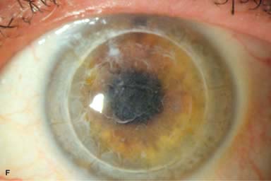 corneal dystrophy gelatinous drop epithelial
