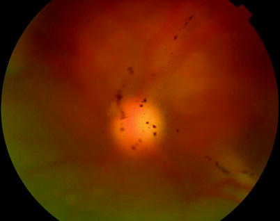 Proliferative Vitreoretinopathy | Ento Key