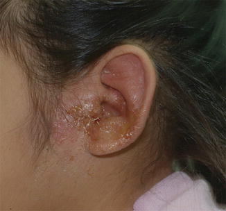 Staph Infection Outer Ear