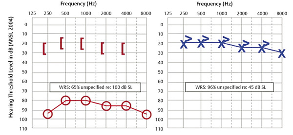 kondensator annoncere Forbindelse Pearls in Audiovestibular Assessment | Ento Key