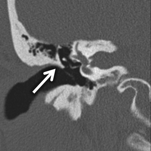 scutum temporal bone