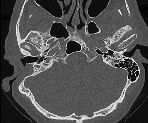 Granular Myringitis