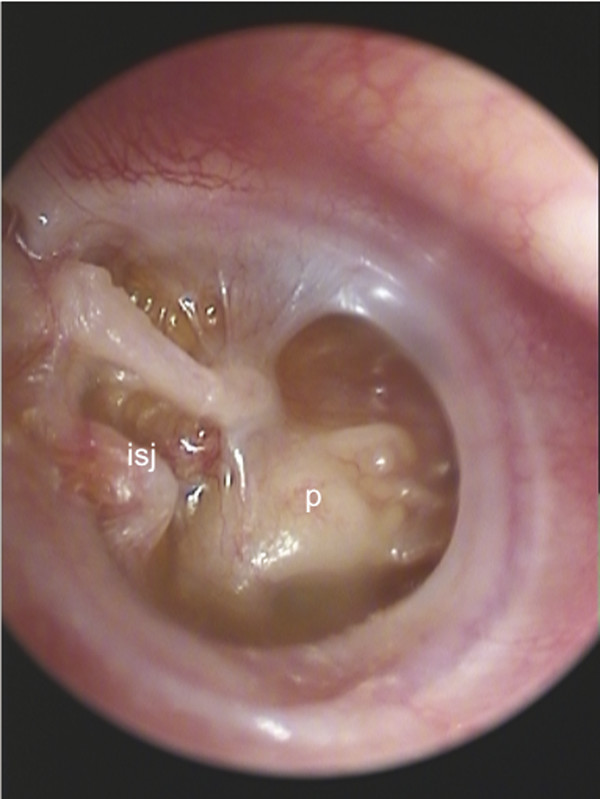 tympanic membrane abnormal