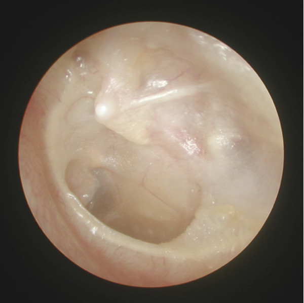 aural polyp