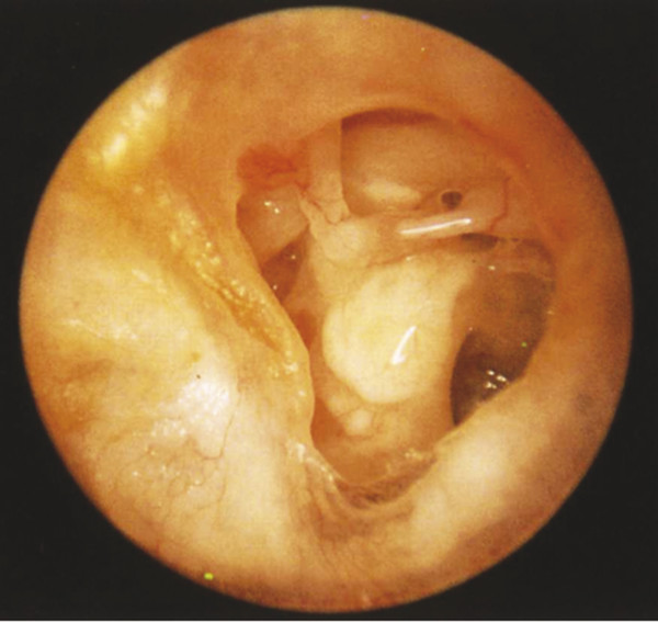 aural polyp