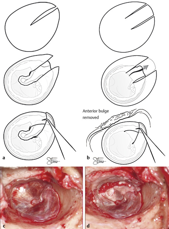 Overlay Tympanoplasty Technique | Ento Key