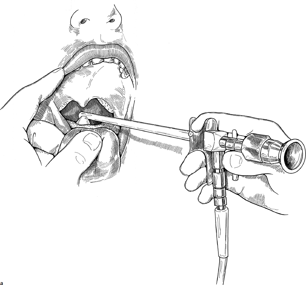 Laryngoscopy Ento Key