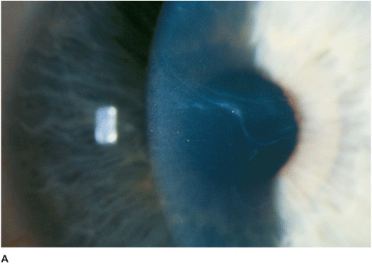 epithelial basement membrane dystrophy