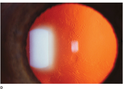 epithelial basement membrane dystrophy