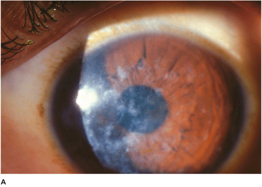 What Is Corneal Stromal Opacities