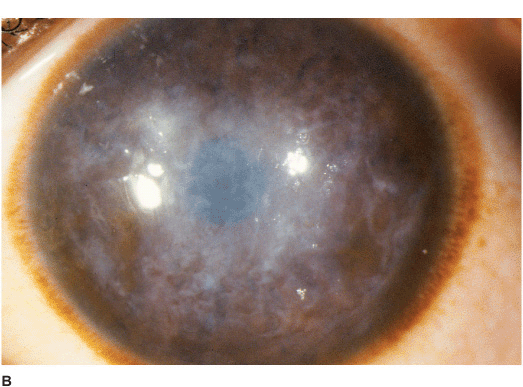 Corneal Dystrophies | Ento Key