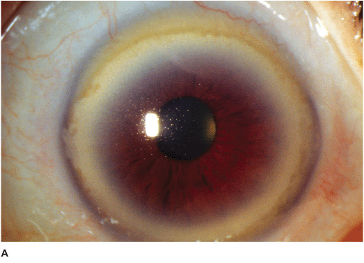 corneal degeneration treatment