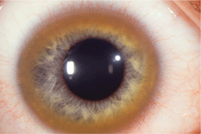 hurler syndrome corneal clouding