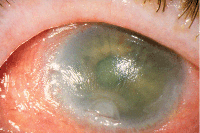 Systemic And Immunologic Conditions Affecting The Cornea Ento Key