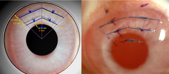 corneal vascularization riboflavin