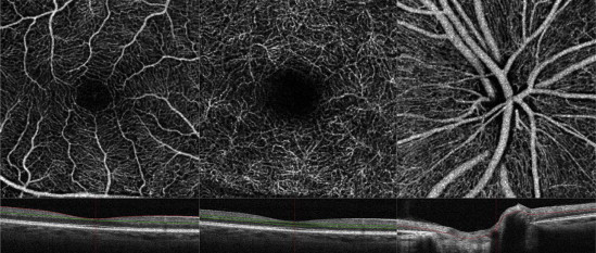 optical coherence tomography diabetic retinopathy