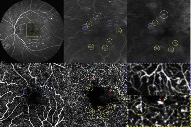 optical coherence angiography