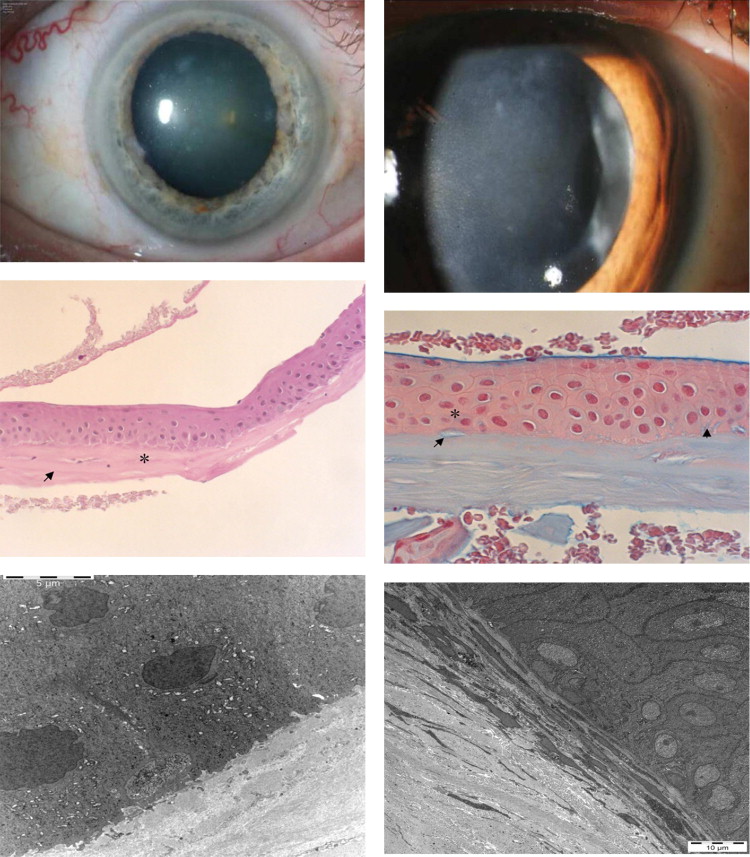 Franceschetti Hereditary Recurrent Corneal Erosion | Ento Key